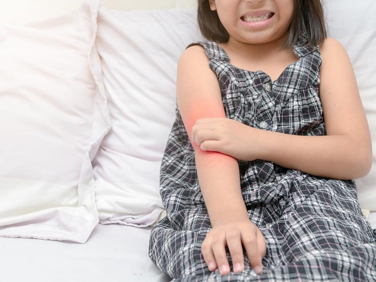 No hay buenas formas de evitar el eccema infantil, pero sí muchas opciones de tratamiento