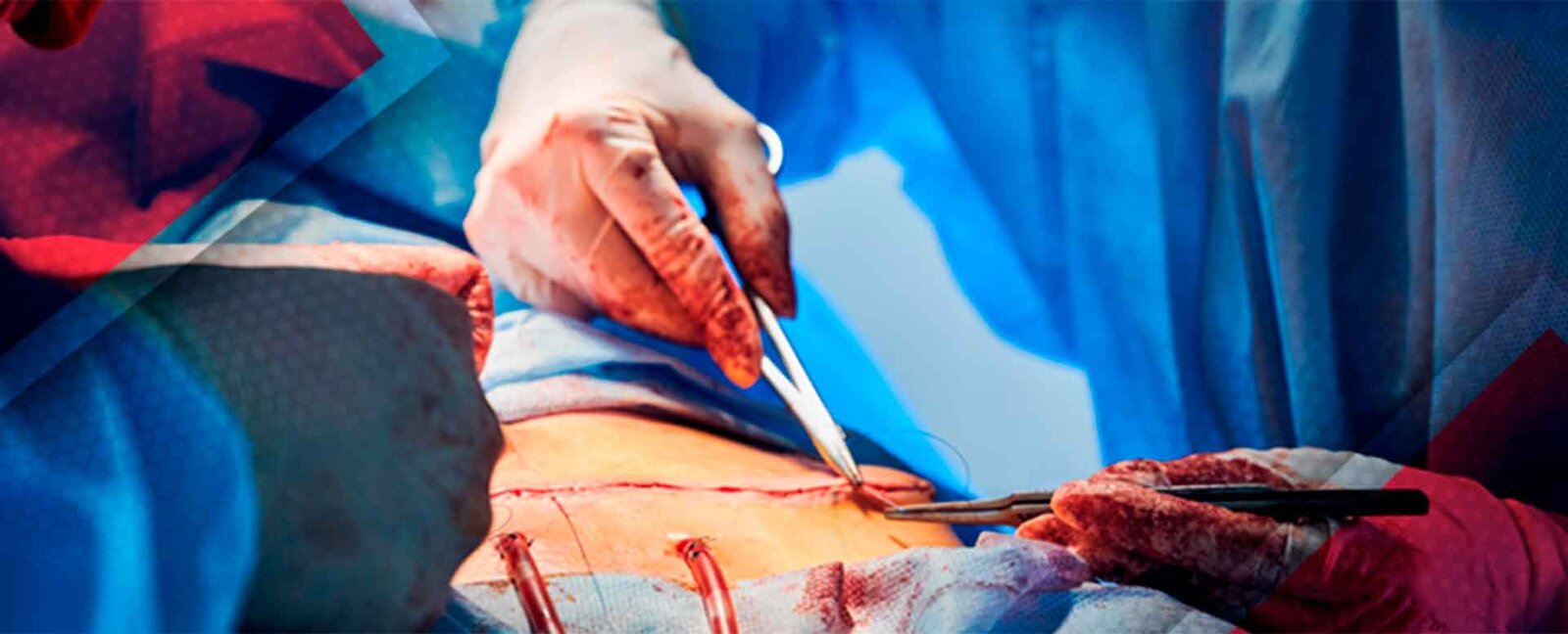  Un antibiótico extra no reduce el riesgo de infección durante la cirugía para corregir fracturas complejas