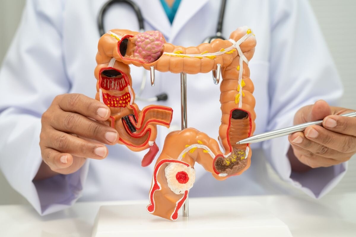El cáncer de colon es una de las enfermedades oncológicas más frecuentes y, al mismo tiempo, una de las más prevenibles. Sin embargo, suele