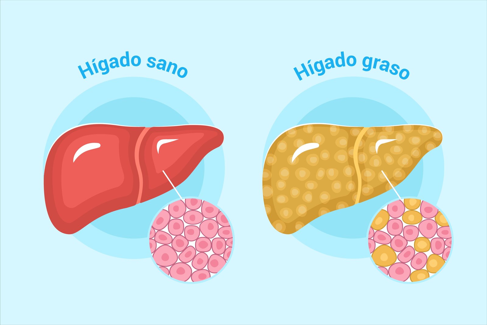 Identifican factores de riesgo metabólicos asociados a la MASLD