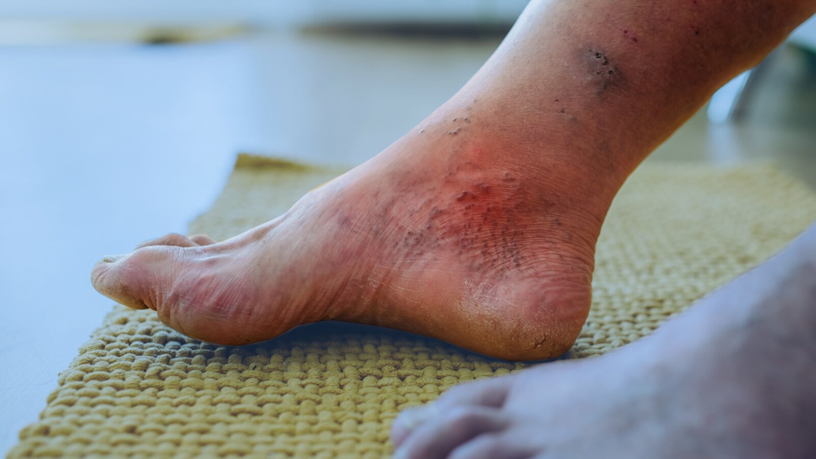 Señales de alerta en los pies que indican complicaciones por diabetes