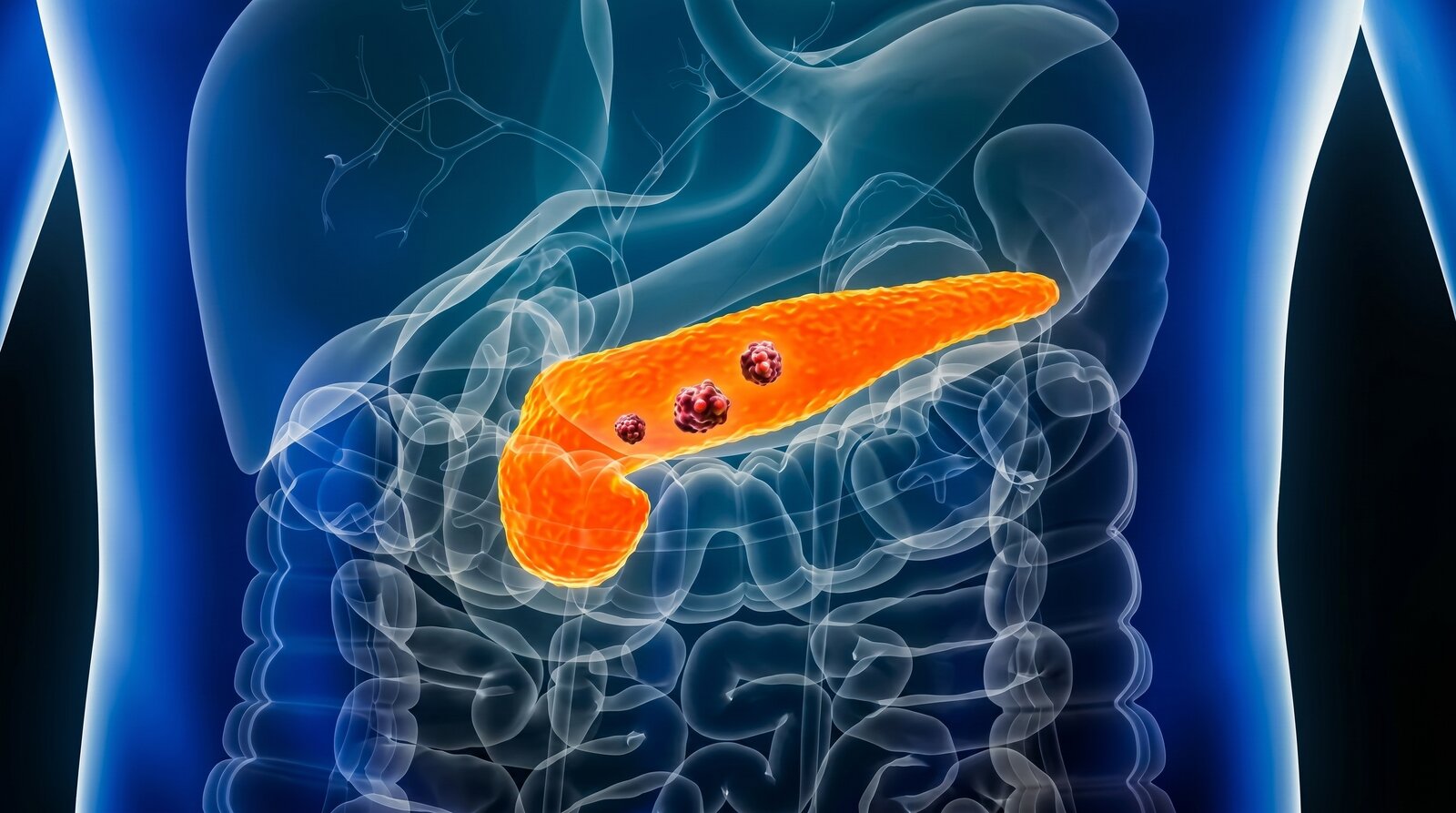 Cáncer de páncreas: descubren una proteína que protege al tumor