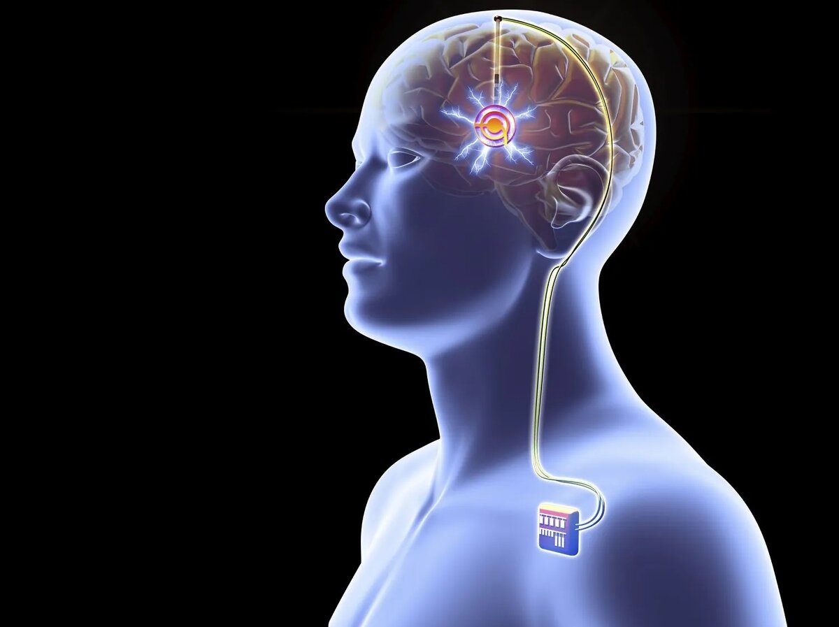 Nueva técnica de estimulación cerebral mejora los síntomas del Parkinson sin cirugía