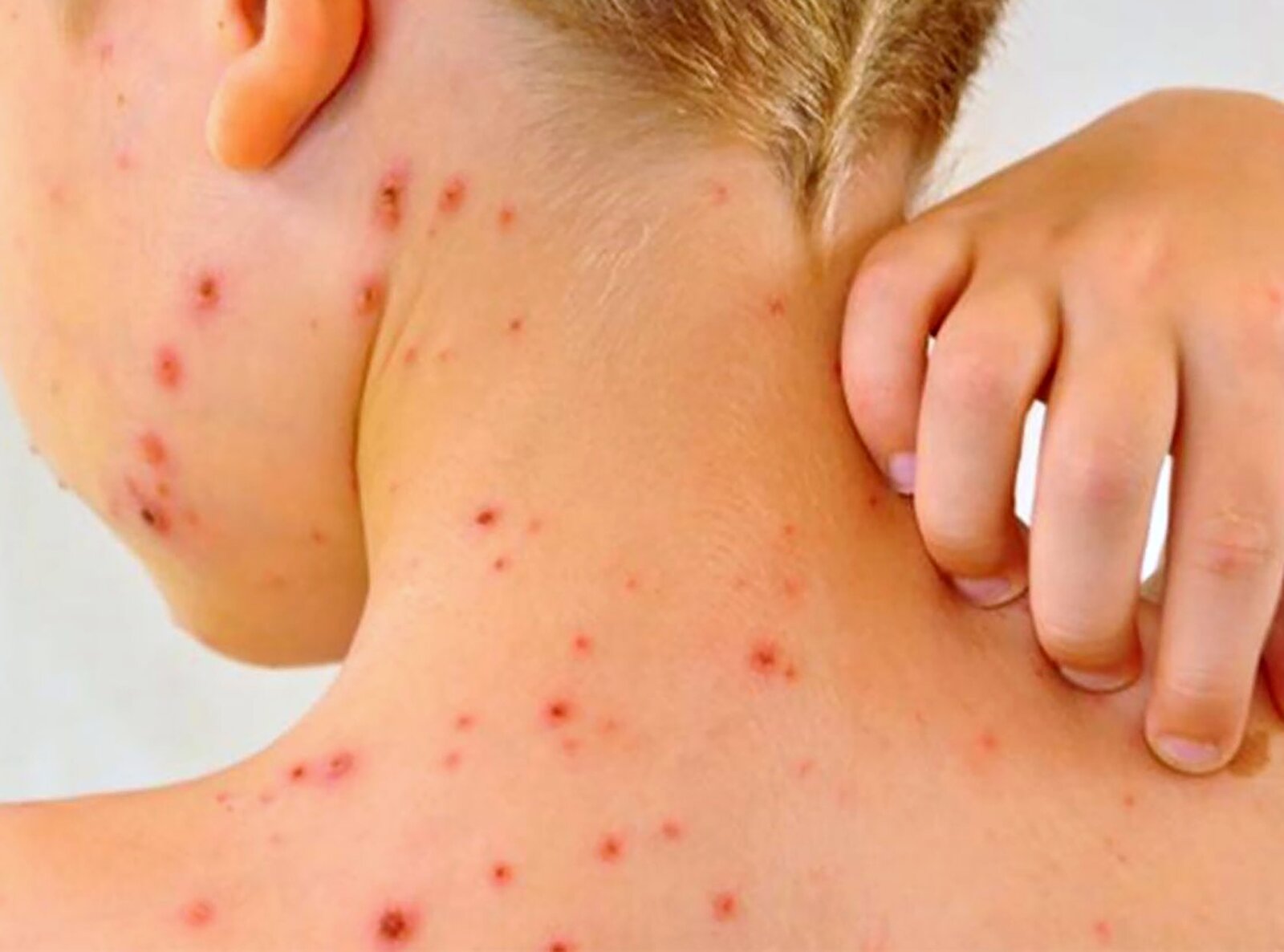 Sarampión y enfermedades respiratorias podrían transmitirse