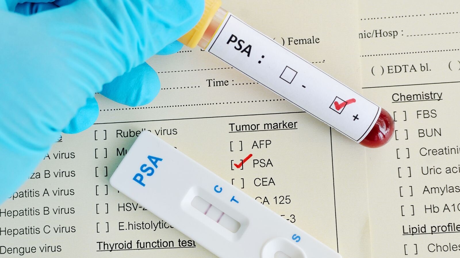 Detección del cáncer de próstata: un estudio indica que la prueba de PSA podría ayudar