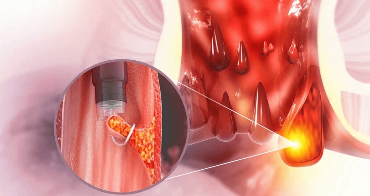 Hemorroides con picazón: las causas ocultas detrás del ardor e irritación anal