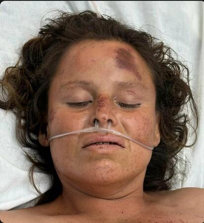 Una mujer de 39 años de edad falleció luego de permanecer varios días hospitalizada a consecuencia de las graves lesiones sufridas en un atropellamiento