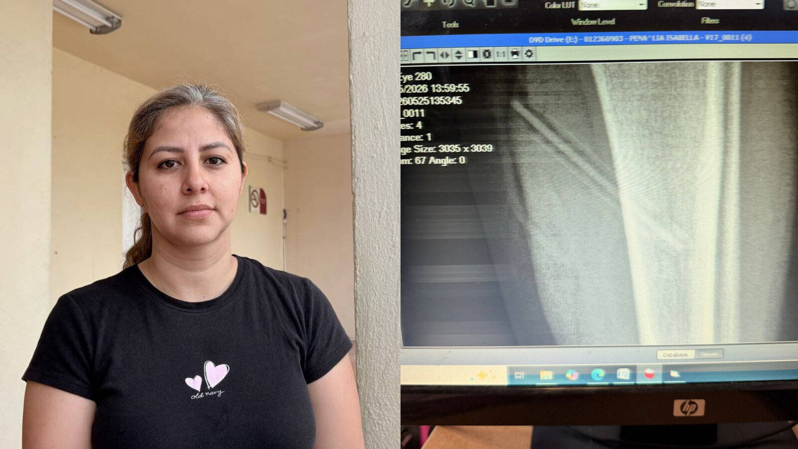 Niña se encaja lápiz en escuela y requiere cirugía de inmediato