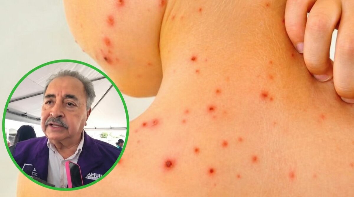Secretaría de Salud investiga rickettsiosis tras fallecimiento de menor en Monclova