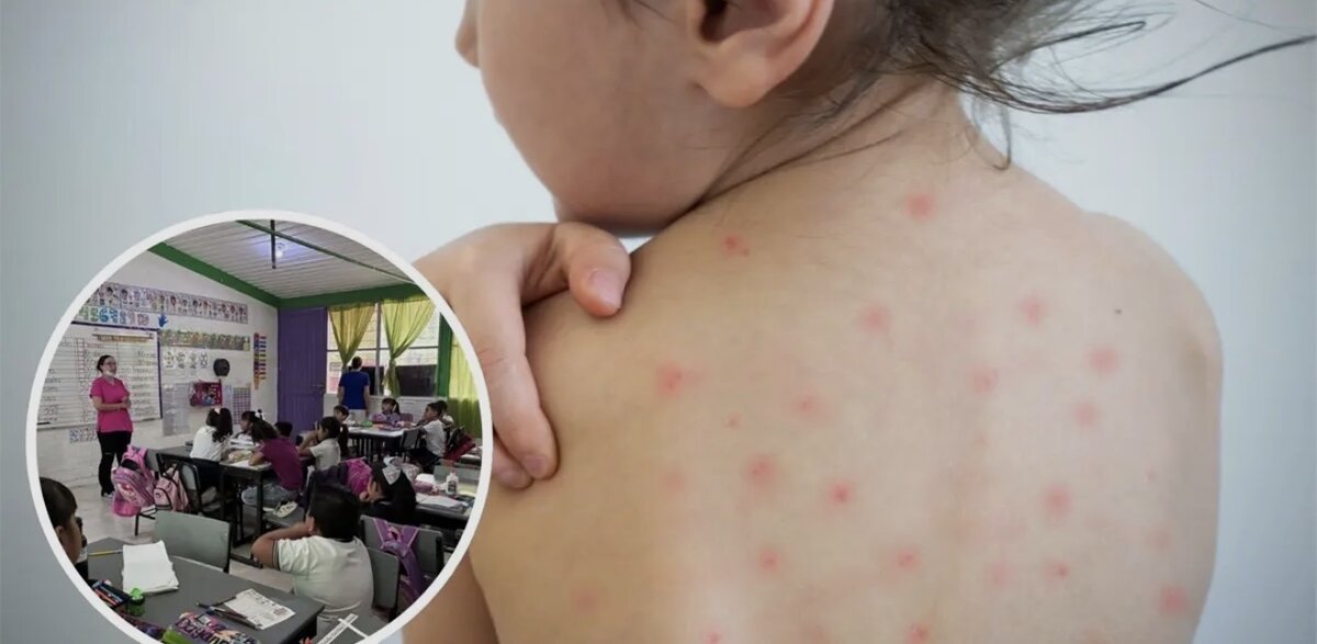 Detectan 10 casos de varicela en escuela de la colonia Cumbres