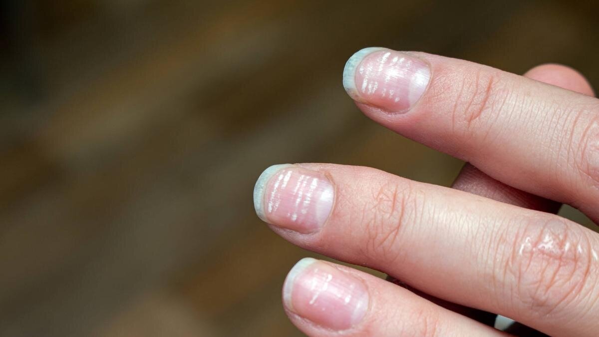 ¿Tus uñas tienen esta señal? Podría estar relacionada con anemia