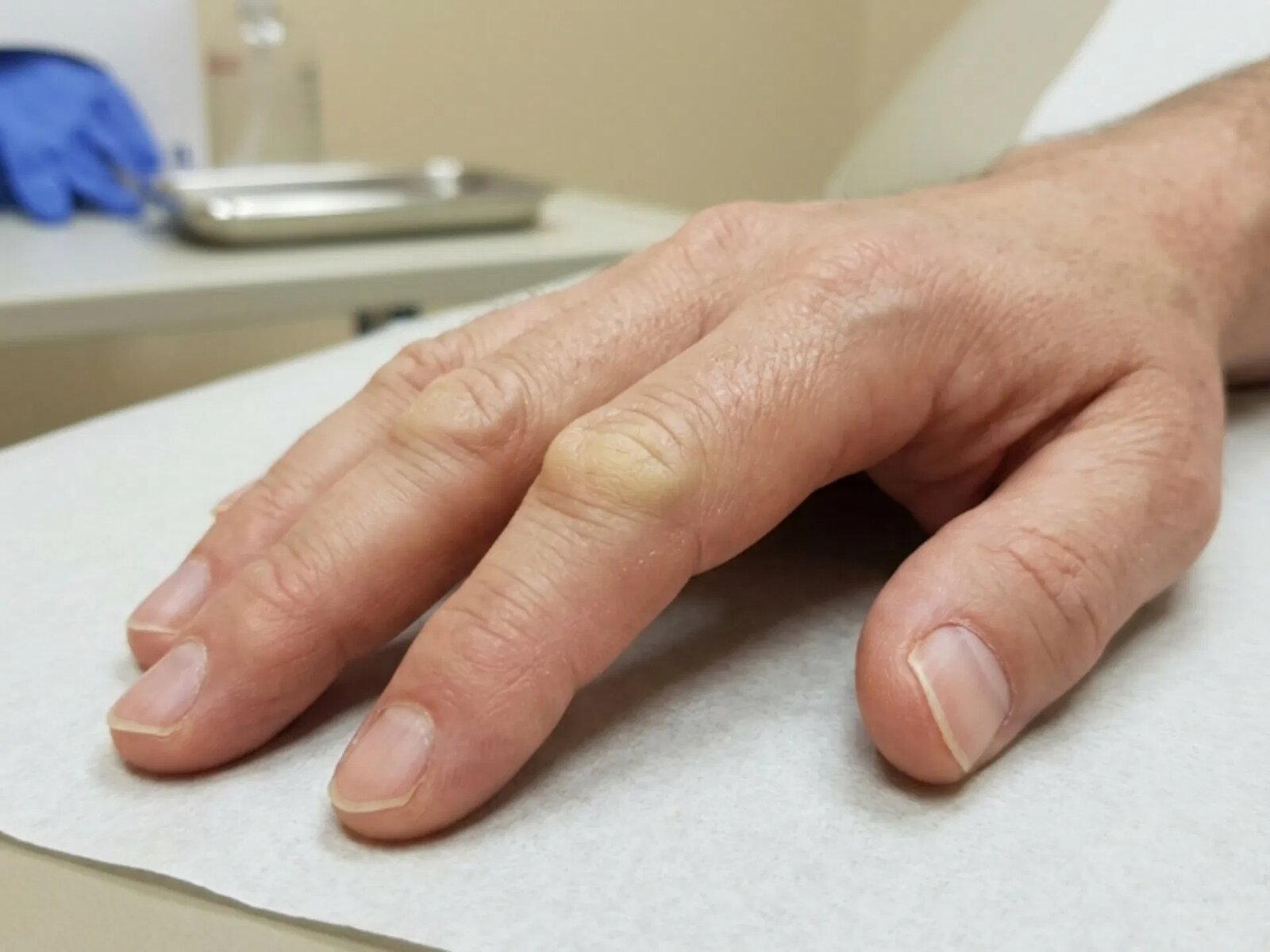 La señal en tus dedos que algunos médicos relacionan con niveles elevados de glucosa