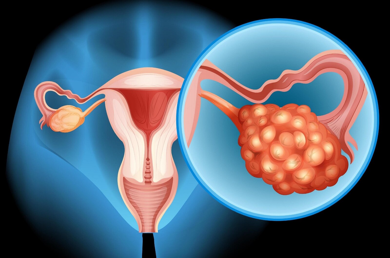 Los síntomas del SOP que muchas mujeres ignoran y podrían afectar su salud