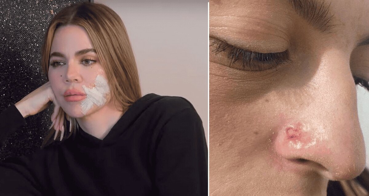 Carcinoma y melanoma: las diferencias clave entre los dos cánceres de piel más frecuentes