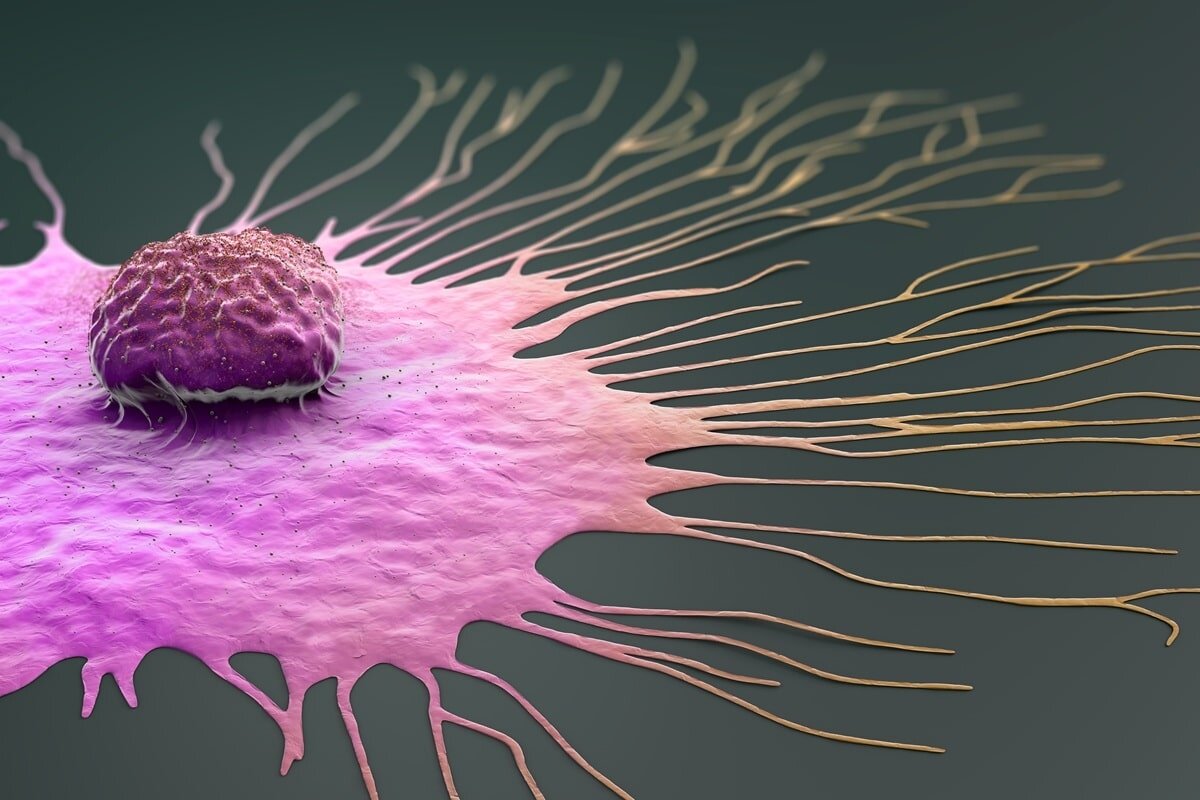 ¡La metástasis no siempre es el final! Así está cambiando la inmunoterapia el pronóstico del cáncer