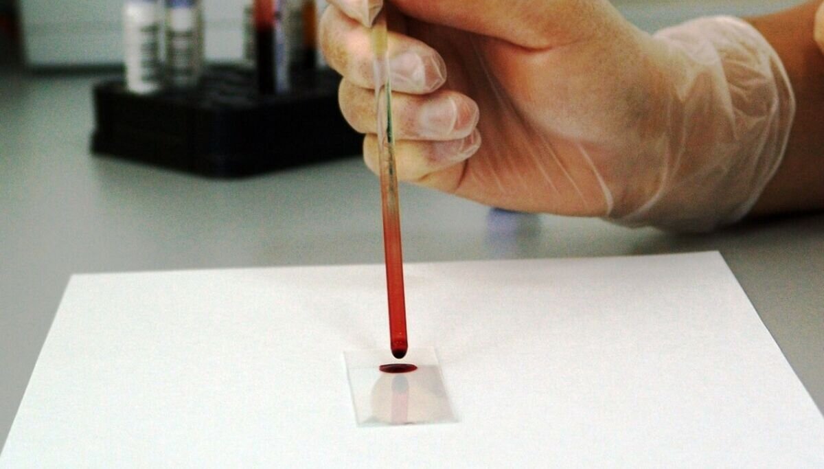 Análisis de sangre de nueva generación mejora la detección del cáncer de próstata agresivo