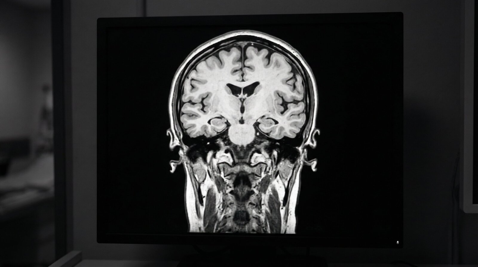 Descubren cómo una proteína cerebral expande la enfermedad de Alzheimer