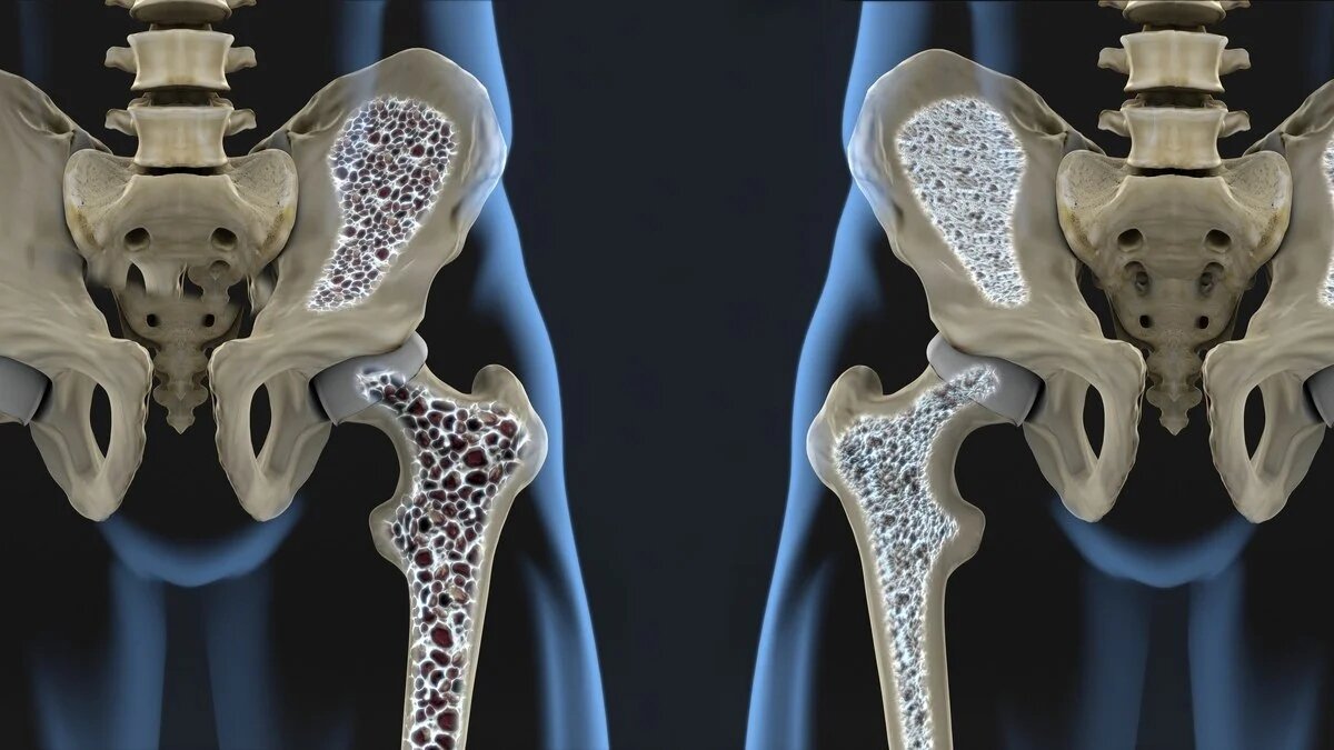 Síntomas silenciosos de la osteoporosis: Señales de alerta antes de la primera fractura