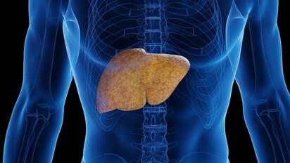 El hígado graso aumenta las probabilidades del cáncer de colon más mortal, según un estudio
