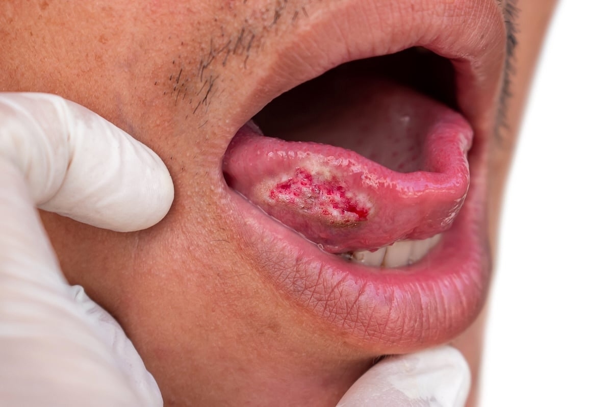 Nueva prueba de cepillado altamente precisa puede detectar cáncer de boca en menos de una hora