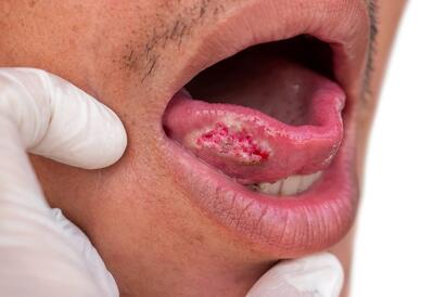 Nueva prueba de cepillado altamente precisa puede detectar cáncer de boca en menos de una hora