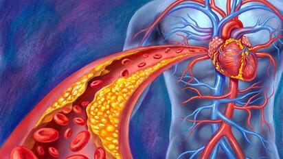 No es solo el colesterol LDL: cuál es la proteína sanguínea que es clave para evaluar el riesgo cardiovascular