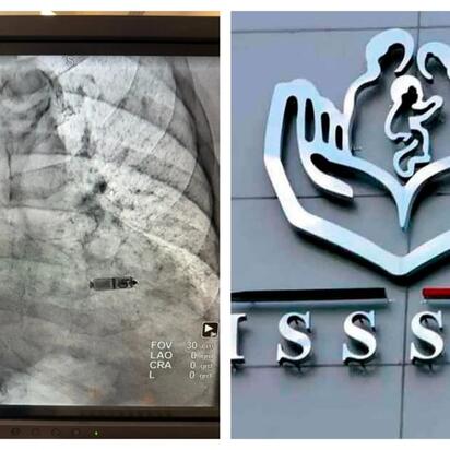 ISSSTE implanta por primera vez un marcapasos sin cables a un paciente de 89 años en Nuevo León