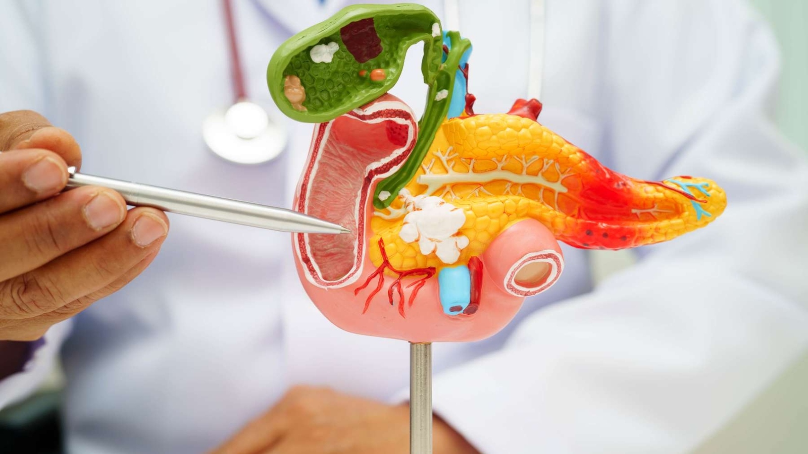 ¿Podría una vacuna prevenir el cáncer de páncreas en personas con alto riesgo?