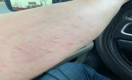 Reportan dermatitis tras uso de agua turbia en Piedras Negras