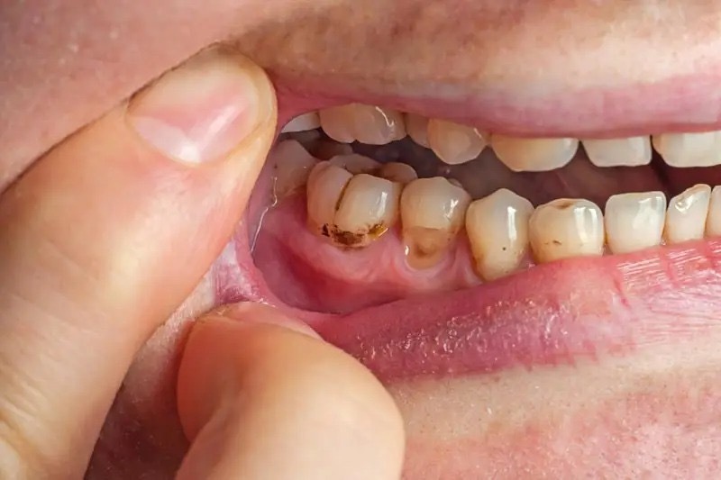 Bucal: además del cepillado correcto, es indispensable utilizar hilo dental Bucal: además del cepillado correcto, es indispensable utilizar hilo dental