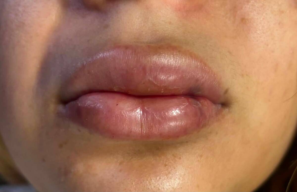 Labios deformados revelan fraude detrás de tratamientos