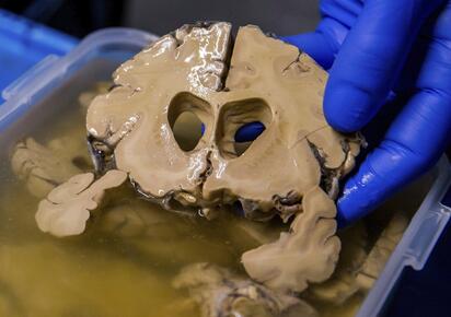 Nueva tecnología busca ampliar el tratamiento de aneurismas cerebrales