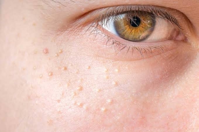 Qué son esas bolitas blancas alrededor de los ojos que no son acné
