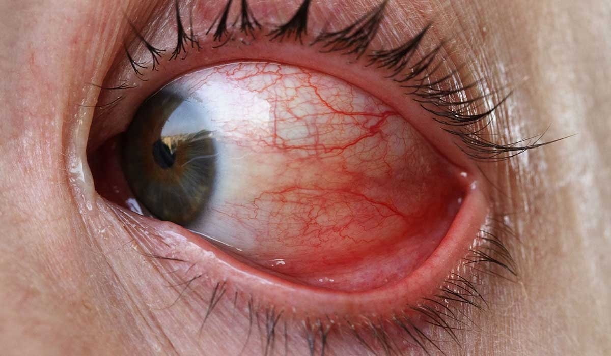 Los ojos rojos son un problema bastante común y con frecuencia aparecen por causas pasajeras, como falta de sueño, sequedad ocular o irritación. Sin embargo,