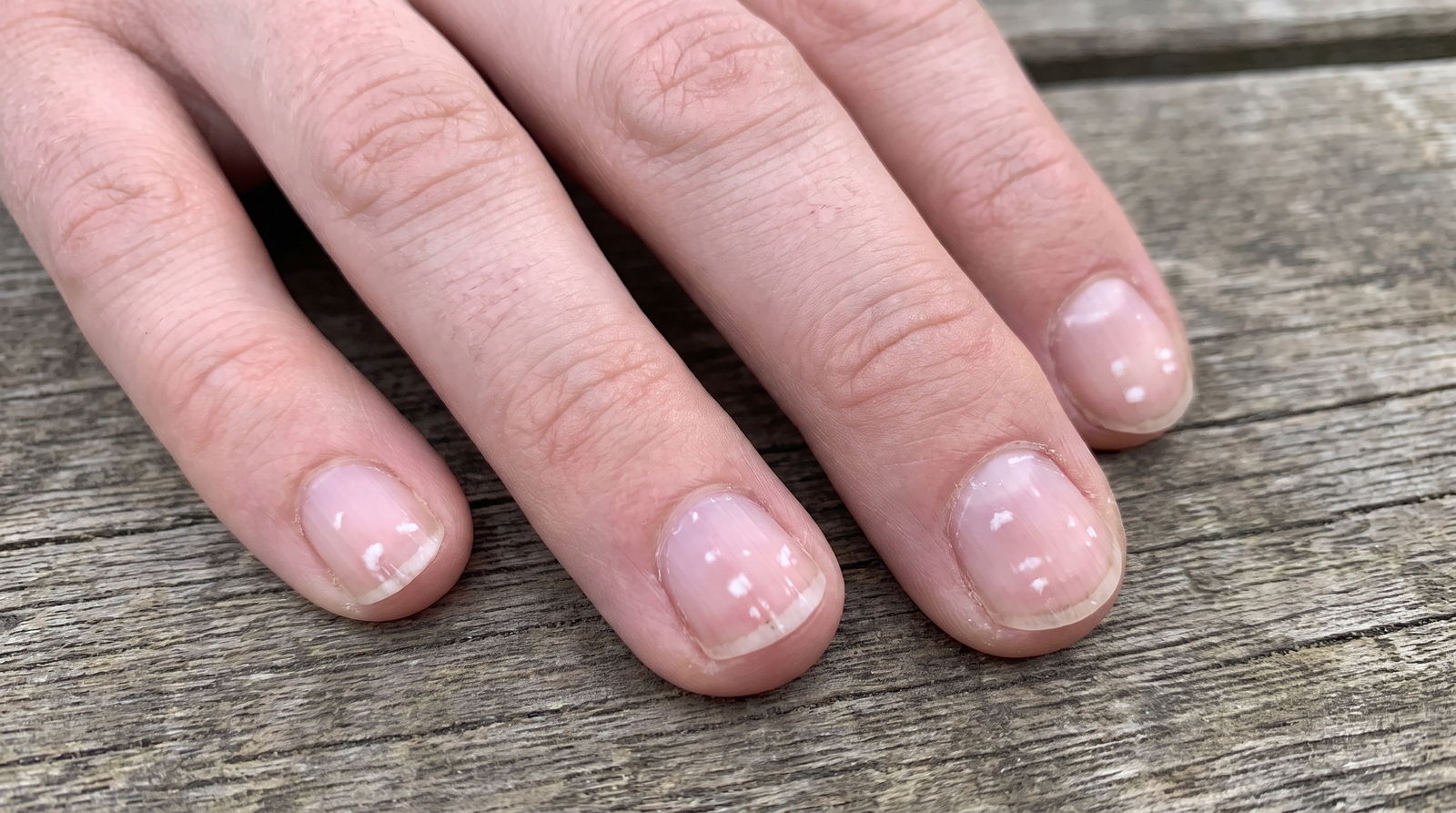 Manchas blancas en las uñas: qué pueden indicar y cuándo consultar