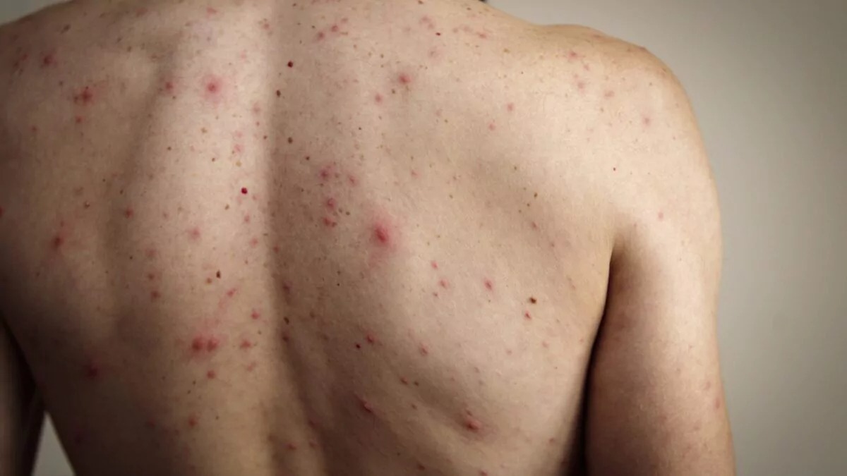 Estados Unidos registra 2 mil 566 casos de sarampión y 38 brotes