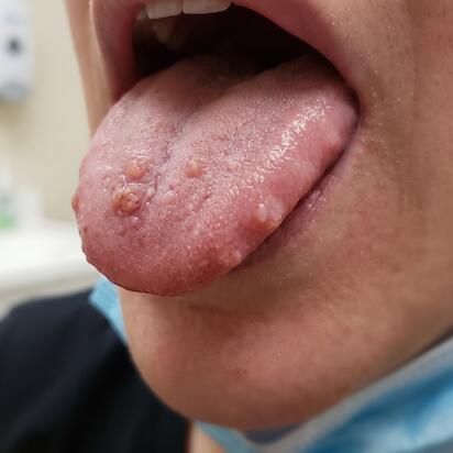 Bultos en la lengua: qué los causa y cuándo conviene consultar