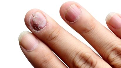 Cambios en las uñas que podrían ser una enfermedad del corazón