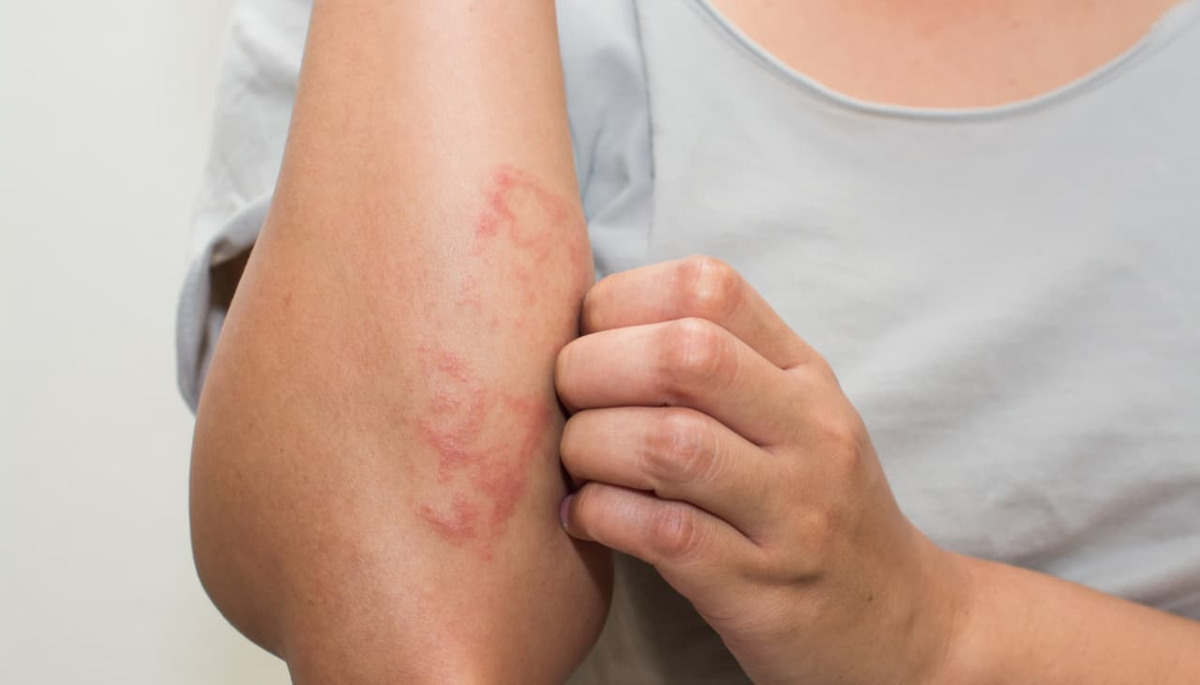 ¿La comezón en la piel puede ser una señal de cáncer?