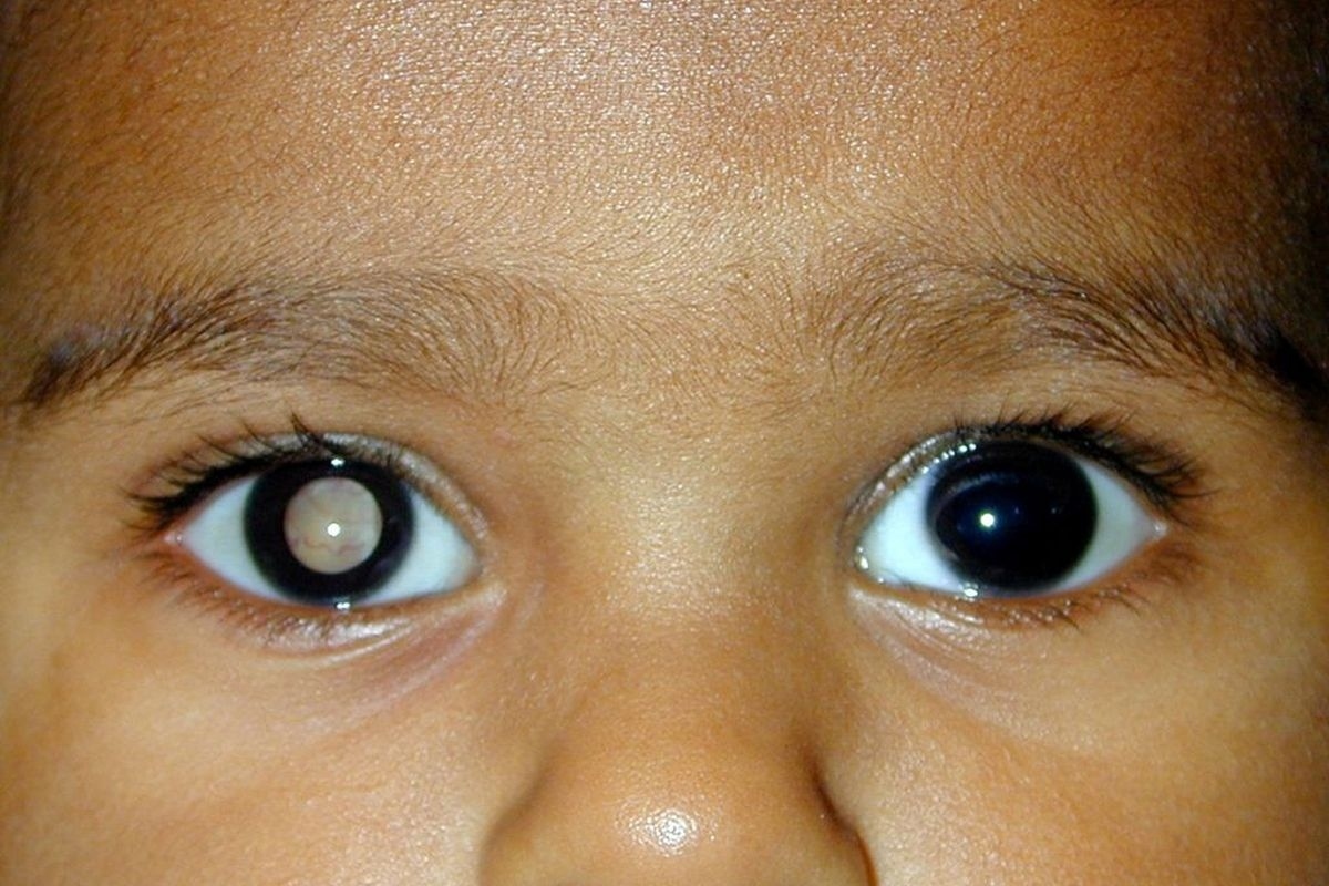 Síntomas del cáncer ocular: Señales de alerta que no debe ignorar