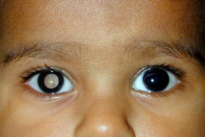 Síntomas del cáncer ocular: Señales de alerta que no debe ignorar