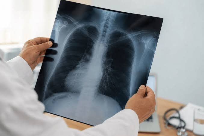 Microplásticos en pulmones: estudio revela mayor presencia en pacientes con cáncer