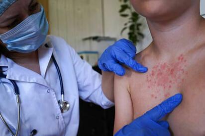 Brote de sarampión en Bangladesh deja más de mil niños muertos