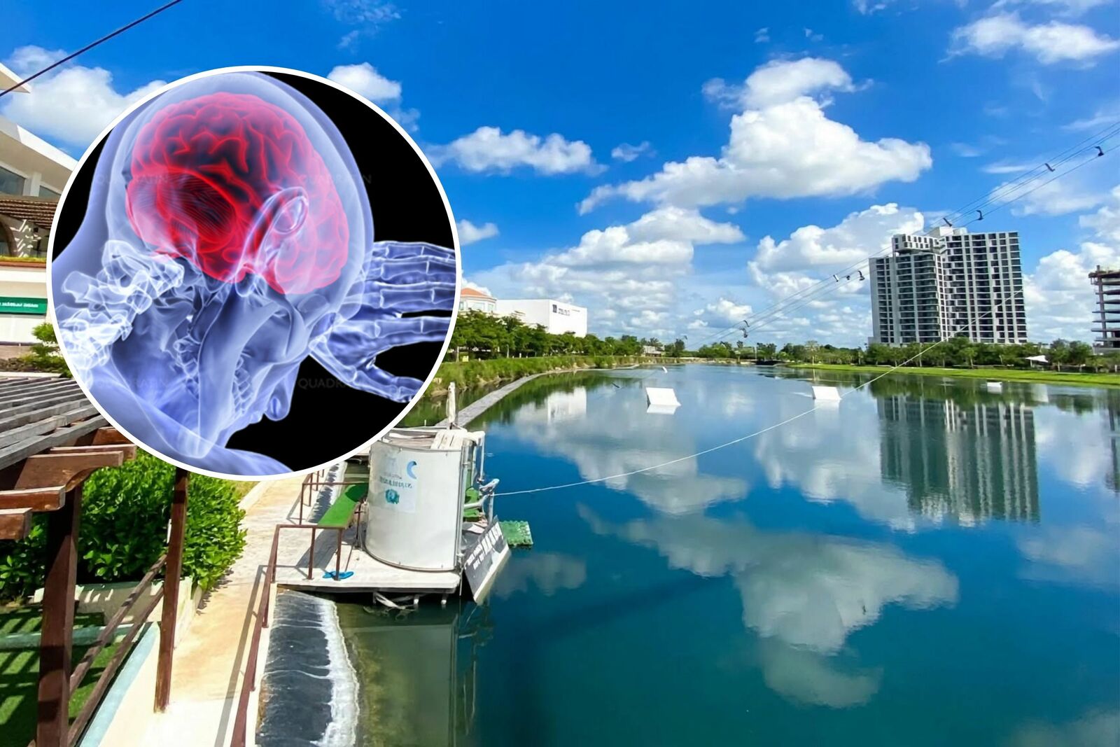 Fallece hombre en Mérida por probable infección de “ameba comecerebros”