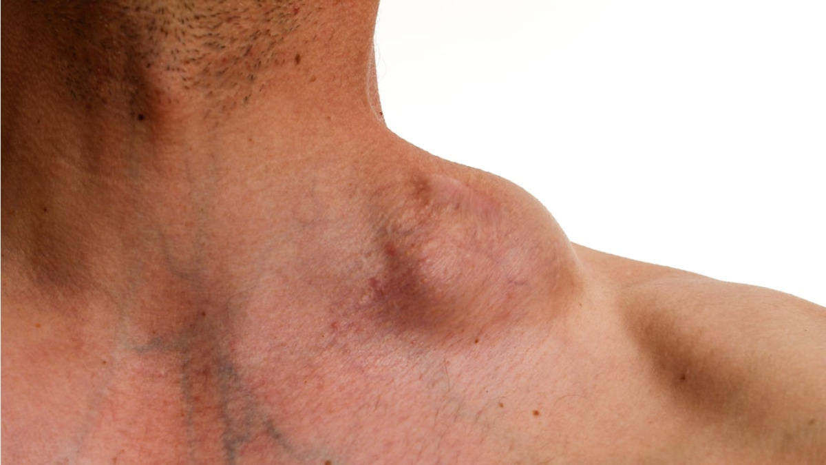 Cuándo un ganglio inflamado en el cuello puede ser una señal de cáncer