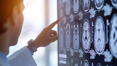 Las señales súbitas de un ACV que exigen atención médica urgente