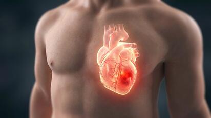 Infarto: por qué actuar rápido puede marcar la diferencia y cuáles son los factores 
