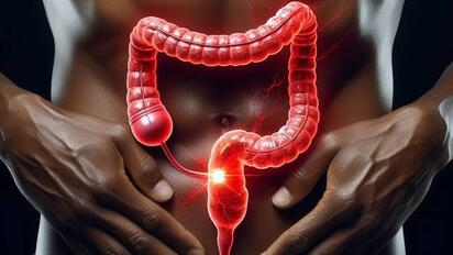 Cáncer colorrectal en adolescentes: muchos casos se detectan en etapas avanzadas