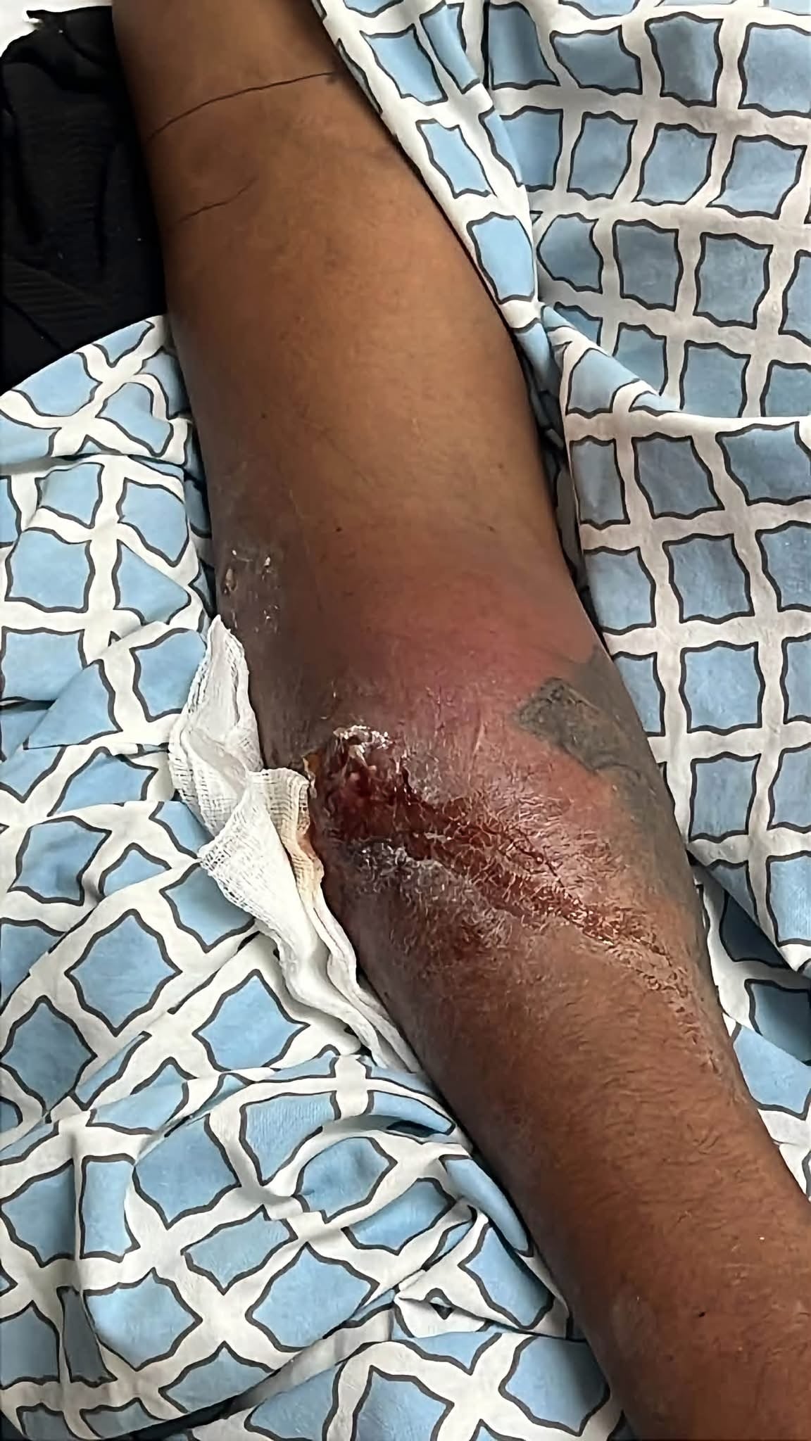 Hospitalizan a hombre tras presunta picadura de viuda negra