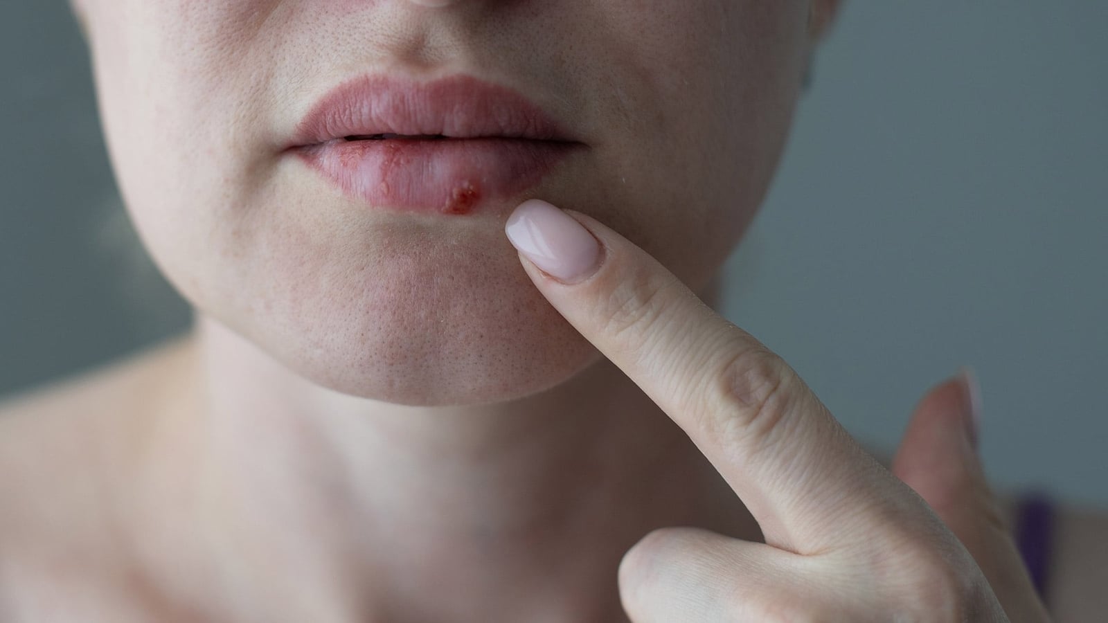 Nuevo fármaco contra el herpes resistente